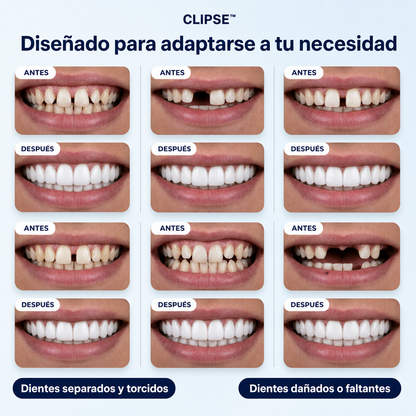 Carillas Dentales Medicas Universales Porcelana